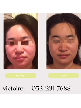 ヴィクトワール(Victoire)/歪みやむくみ等小顔プランは豊富