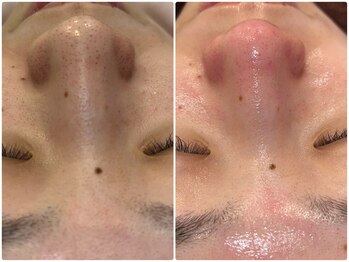 エルマナ(Hermana)/毛穴ケアビフォーアフター