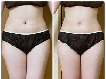 ヨサパーク オリーブ 小倉南店(YOSA PARK olive)/短期間で集中ダイエット！