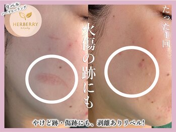 ハーバリー 天王寺(HERBERRY)/ハーブピーリング専門店HERBERRY