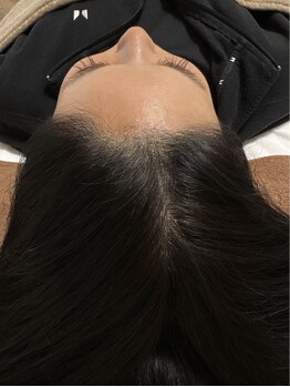 アマリージョヒラソル/Lit ヒト幹細胞エステ