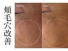 エトレ(etre)/カーボキシー/毛穴/肌質改善