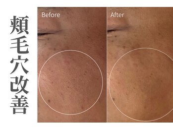 エトレ(etre)/カーボキシー/毛穴/肌質改善