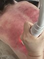 メディカル整体院&nbsp;スライドカッピング/デトックス/血流促進/肩こり、腰痛解消