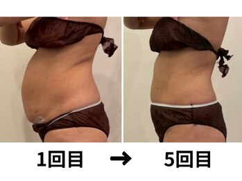 ニコ センター南店(nico)の写真/【結果主義＝本気痩身】“セルライトゼロ” で、頑固な脂肪や凹凸セルライトに激アプローチ！！