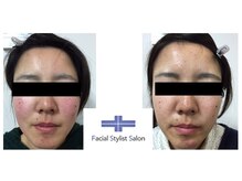 フェイシャルスタイリストサロン 高崎店(Facial Stylist Salon)/ケア例（56）