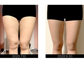 ラグラン銀座メディカルエステ 高輪ゲートウェイ店/【BODY】セルマジ・ビフォアフ