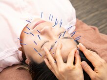 共立総合整骨院 町田鶴川院/肌質改善◎美容鍼コース