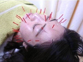 もりわき骨盤鍼灸整骨院 梅田院の写真/【リフトアップ美容鍼】美容鍼で内部からアプローチ！キュッと引き締まった小顔に◎