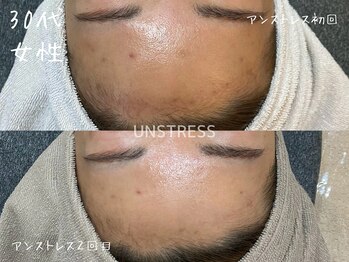 ミコサロン(miko salon)/乳酸菌ピーリング