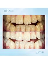 リラパドマ 千葉店(Rela Padma)/【ホワイトニング】