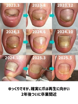 変形爪再生の道のり