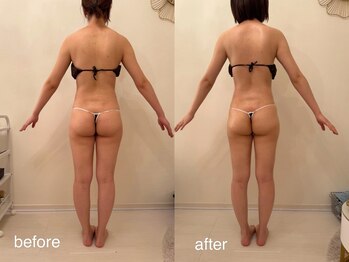 クロレ 浦和店(CLORE)/20代のお客様/4回施術