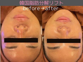 シエスタ(siesta)/韓国脂肪分解リフト(全顔)