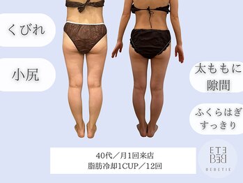 ベベティー(BEBETIE)/お腹に脂肪冷却、なのに美脚?!
