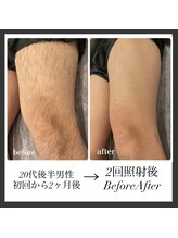 エリクサー 熊谷店(Elixir)/20代後半2回照射