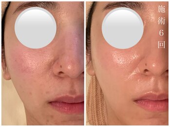 ダン(dan)/【陶肌トリートメント】症例