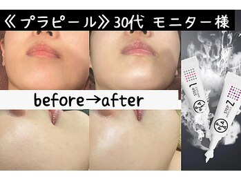 サロンスペース/水光肌【プラピール】2回目