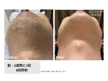 スプレール 水戸店/メンズ髭脱毛
