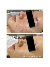 エッセンシャル アイビューティー(Essential)/プラズマシャワー Before→After