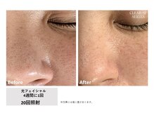 レア(Le'a)/【光フェイシャル】