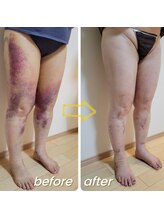 サロン ポム(salon pom)/◇術後インディバ◇