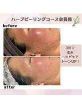 ビューティースリム リボーン 銀座店(reborn)/【ハーブピーリング】の変化！