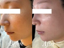 ローズルート(Rose route)/20代前半　シミケア7回施術