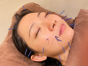 とんとん整骨院 ときわ台店の写真/美容鍼で気になるホウレイ線・たるみケア!年齢を感じさせないお肌へ♪お肌の深部から改善し、ハリツヤUP☆