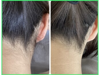 クリア 尾張旭店(Clear)/【Clear脱毛ビフォーアフター】