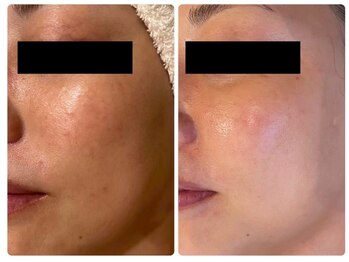 エイシスグロウ(asis glow.)/ララピール×水玉リフティング