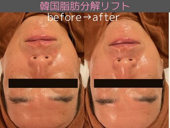 シエスタ(siesta)/韓国脂肪分解リフト(全顔)