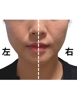 ユニ(Uni)/右側のみ施術例