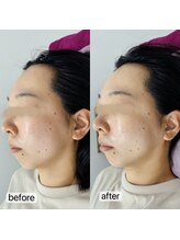 トゥインクル(Twinkle)/顔全体がスッキリ！