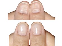 アメジスト(Amethyst)/デコボコ生える爪の自爪育成