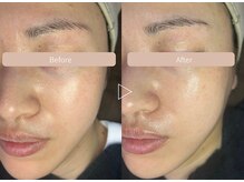 セレーノ 白金台(seReno)/ララピールBeforeAfter