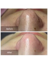 癒える(ielu)/毛穴ケア★1回での変化