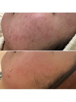 ハーナウ ハウ(hanau hou)/ハーブピーリング効果