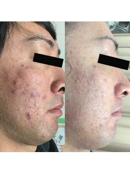 ホワイトアクア 天王寺本店(WHITE AQUA)/ハーブピーリング/大阪/天王寺