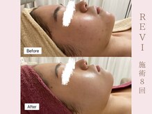 ルア(LuA.)/気になる赤みや跡の改善◎