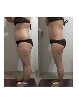 ヨロン(YORON)/脂肪冷却