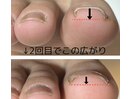 ヘイスイッチ　巻き爪ケア