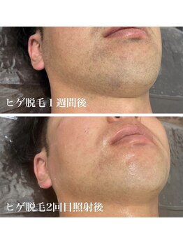 ホッコリ 府中店(HOKKORI)/ヒゲ脱毛～青ヒゲ解消