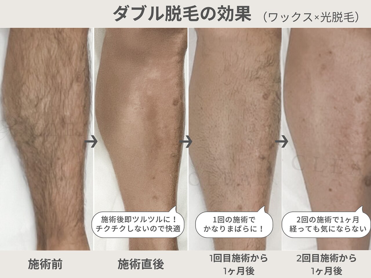 VIO モニターに関するエステサロン ブラジリアンワックス脱毛専門店