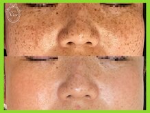 ヴィオール 名古屋栄店(VIOR)/シミ改善　ハーブピーリング