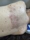 ぴよぴよの写真/帯状疱疹のあとも痛みがある…そんなお悩みも、はり施術が帯状疱疹に効果ありと人気の当店へ♪