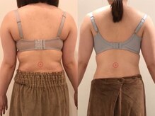 リール 新宿店(RIRE)/30代後半　 バストアップ症例