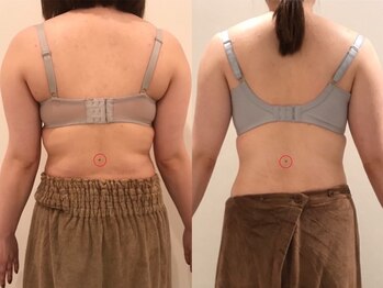 リール 新宿店(RIRE)/30代後半 バストアップ症例