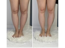 モア(moa)/脚のむくみ　症例写真