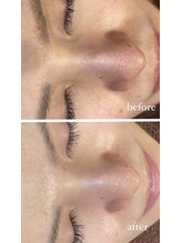 レシェルサロン(Lechelle Salon)/ハーブピーリング